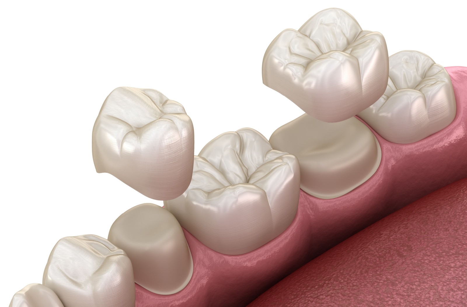 3-D illustration of two dental crowns floating above two filed down teeth.