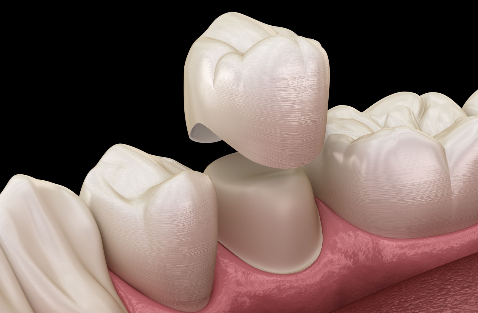 3D illustration of a dental crown floating over a filed down tooth.
