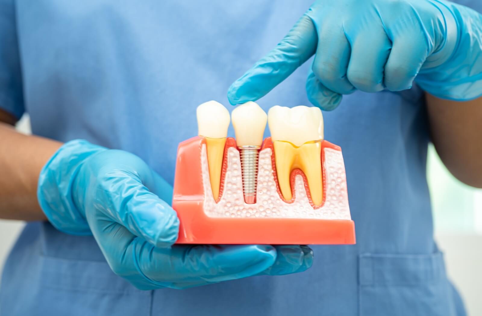 Close-up of person with blue gloves pointing to a model of teeth and dental implant.