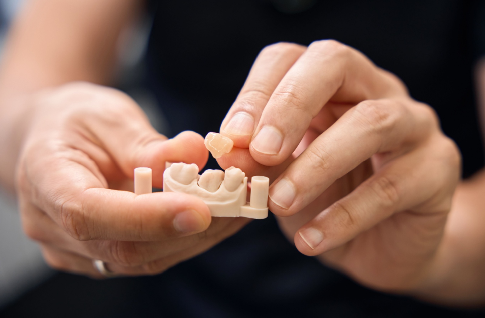 A close-up of a dentist showing how a dental crown covers the targeted tooth using a model.