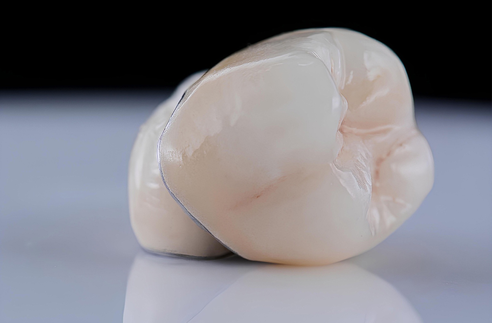 A close-up of a porcelain-fused-to-metal dental crown resting on a table.